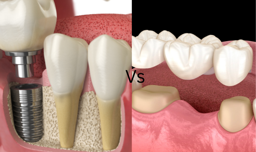 Dental Bridges Vs Dental Implants Las Vegas