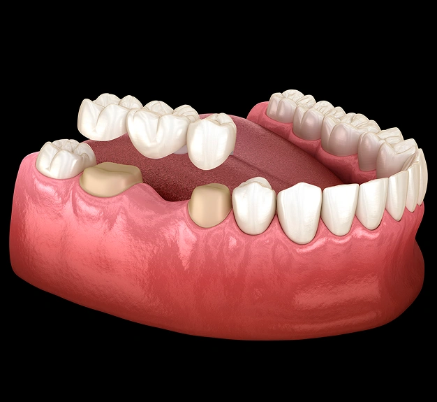 alatorre dental bridges las vegas