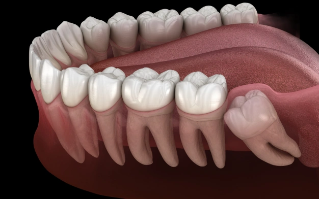 alatorre dental wisdom tooth removal las vegas